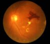 Diabetic retinopath , Dr Mowla