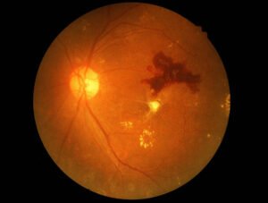 Diabetic retinopath , Dr Mowla