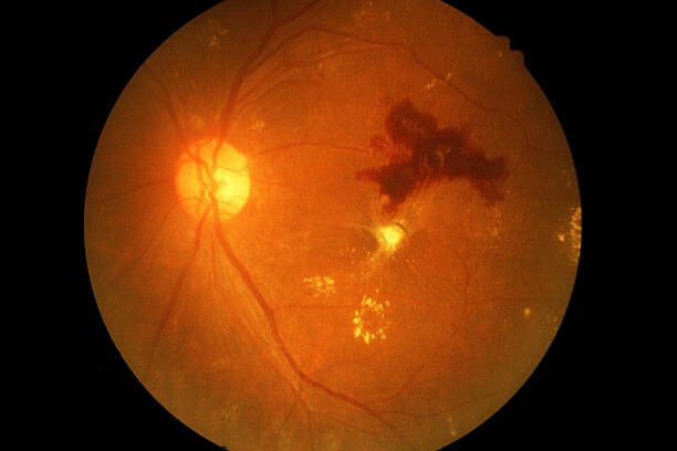 Diabetic retinopath , Dr Mowla