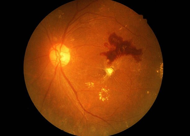 Diabetic retinopath , Dr Mowla